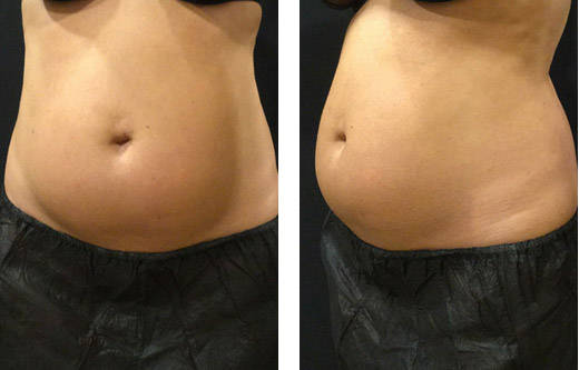 Stomach before CoolSculpting treatment