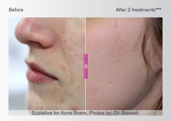 Sublative Acne Treatment